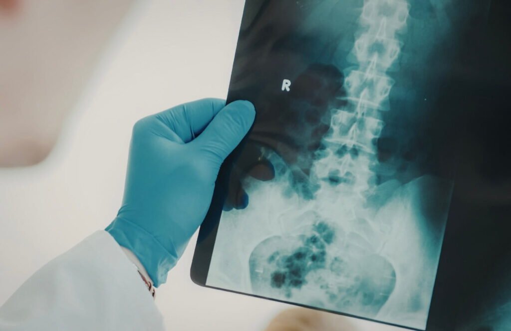 Doctor reviewing spinal X-ray as medical evidence in a personal injury claim